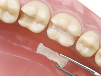 F&uuml;llungstherapie